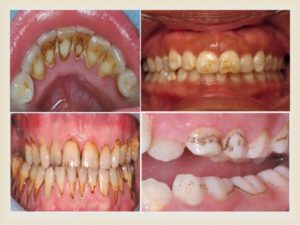 teeth-discoloration-21-638 - Cedar Ridge Dental Maple Ridge | Family Dentistry