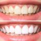How Does Teeth Whitening Work? - Cedar Ridge Dental Maple Ridge | Family Dentistry Illustration of how teeth whitening works, showcasing professional treatment steps for a brighter smile at Cedar Ridge Dental Clinic.